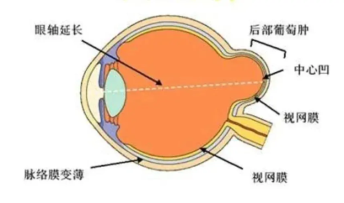巩膜加固手术眼球示意图