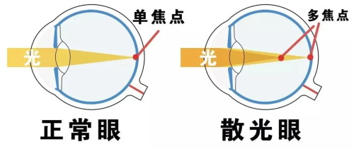 正常眼睛和散光眼镜的对比