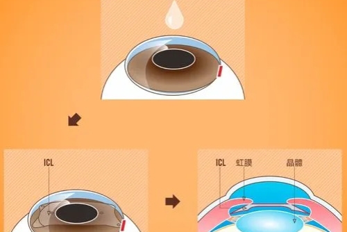 揭秘2024山东近视眼手术价格,激光、飞秒、晶体植入手术多少钱一篇全有~