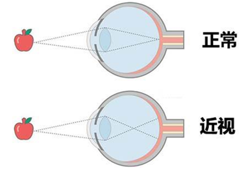 正常眼部视力和近视眼部视力的对比