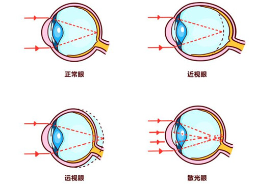 不同眼球状态成像对比示意图