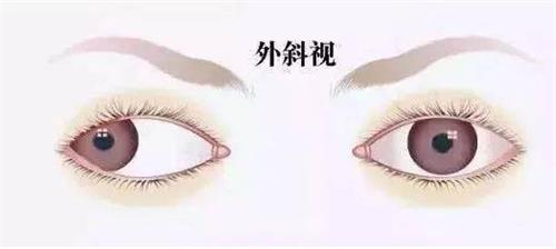 外斜视