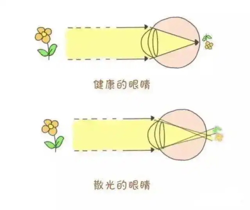 正常眼睛和散光眼镜的对比