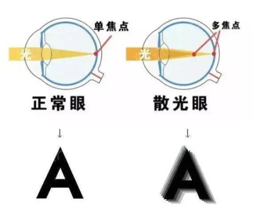 散光看东西的状态