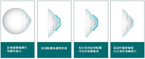 角膜塑形镜佩戴示意图
