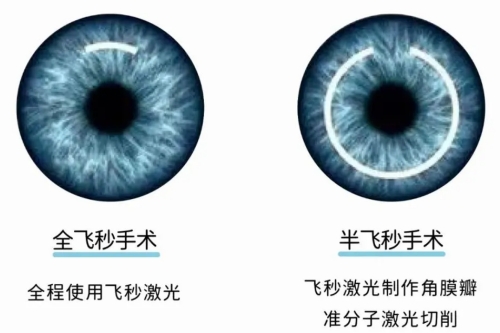 西安近视手术2024价格一览表:想了解的全飞秒/半飞秒/晶体植入收费在这里