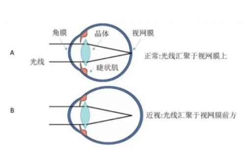 近视手术真没那么可怕!如果您好奇做全飞秒近视手术是什么体验就接着往下看吧!
