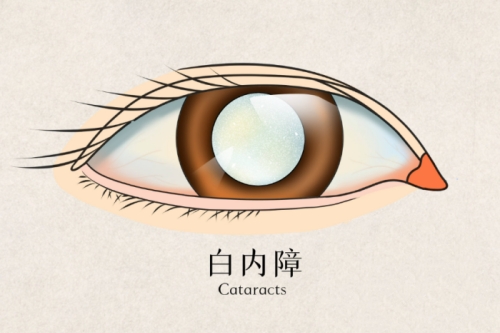 白内障看不清滴眼药水就可以治好?假的别信!本篇文章为您详细分析白内障!