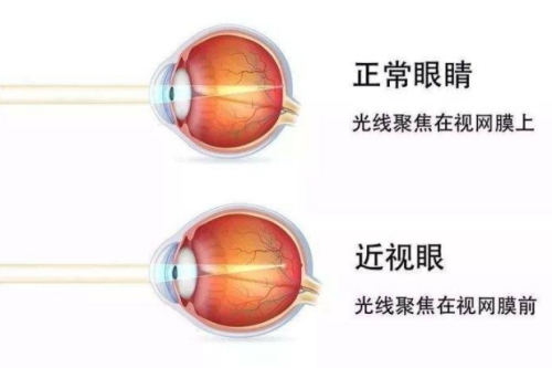 正常眼与近视眼时光的区别