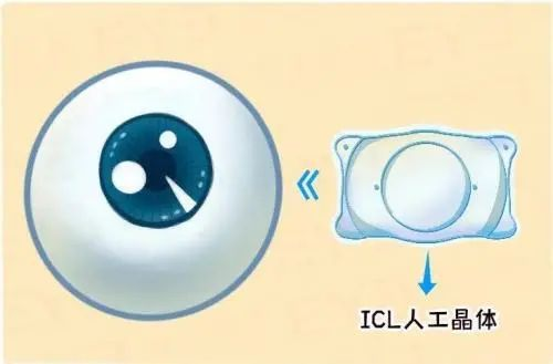 ICL人工晶体示意图