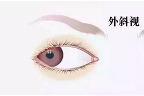 斜视手术术后须知:做完手术这几点不注意就会反复!