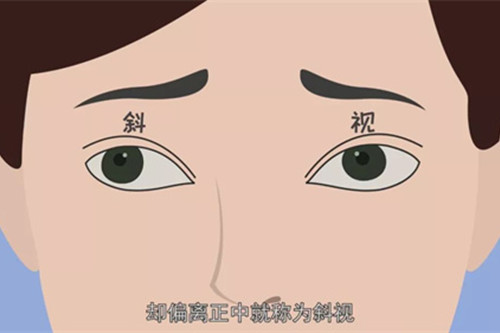 斜视讲解图