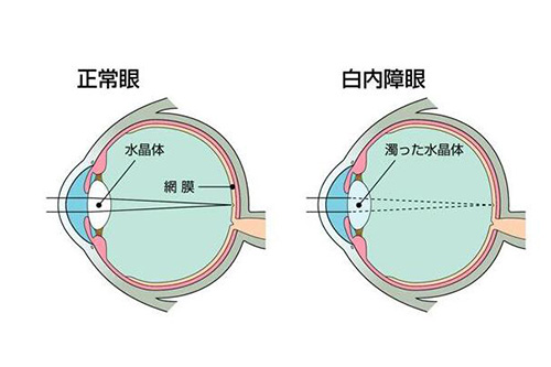 重庆白内障手术免费政策:如何申请|年龄要求|操作流程公开!