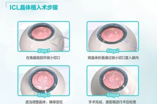 ICL晶体植入手术步骤图