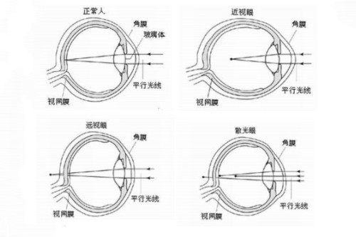 福清预防儿童近视选择哪家眼科?亮睛眼科就可以离焦镜4000+ok镜10000+!