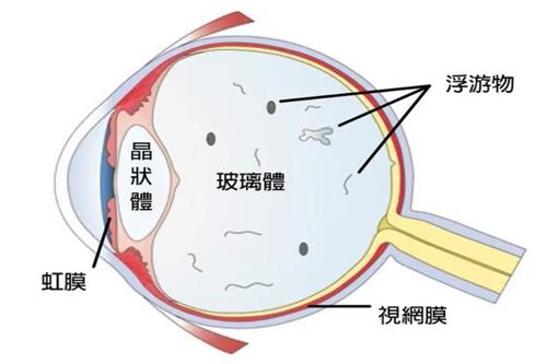 飞蚊症的眼睛