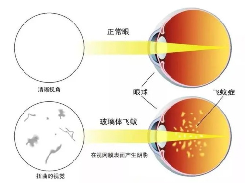 正常眼睛的视力和飞蚊症眼睛的视力