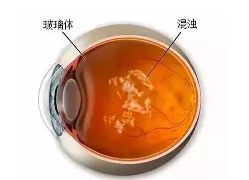 玻璃体浑浊的示意图