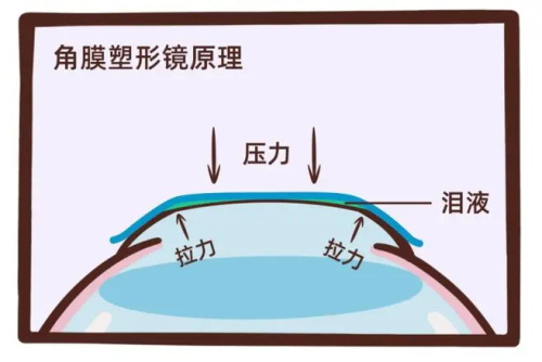 角膜塑形镜的原理