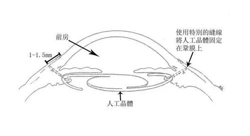 前房型人工晶体的位置