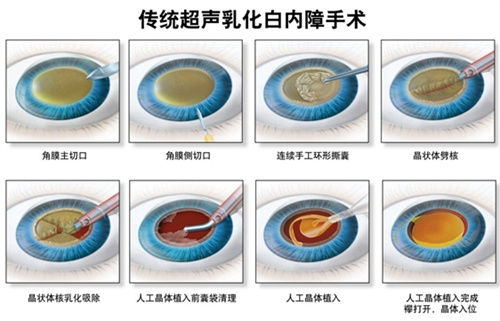 现在白内障手术国内免费吗？有条件的！了解不同地区优惠政策及报销范围