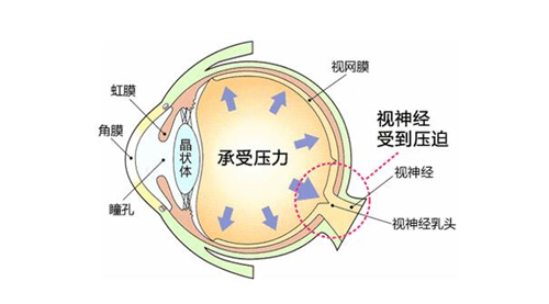 儿童高眼压症能自愈吗？有生理性|病理性区分，包含靠谱改善方式！