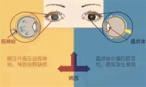 眼压高的原因解析展示图