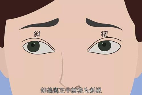 废用性外斜视治不好吗?会越来越斜吗?