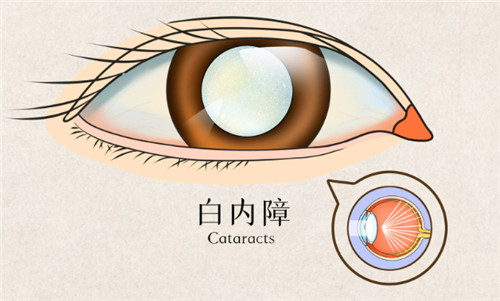 白内障眼睛表现示意图