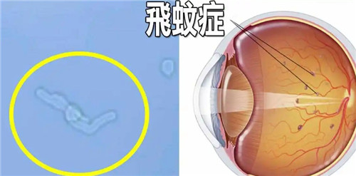 其实飞蚊症也有假性和真性之分您知道吗?文内详解二者的区别!