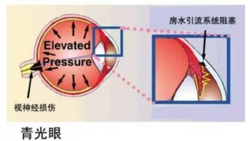 青光眼眼压高怎么办?如何降眼压?