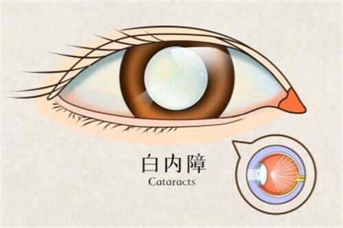 白内障什么时候做手术最佳?有了白内障多久去做手术?抓住白内障治疗的黄金点