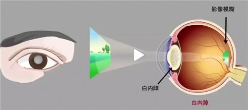 想知道白内障为何发生?十种引发因素都在这里