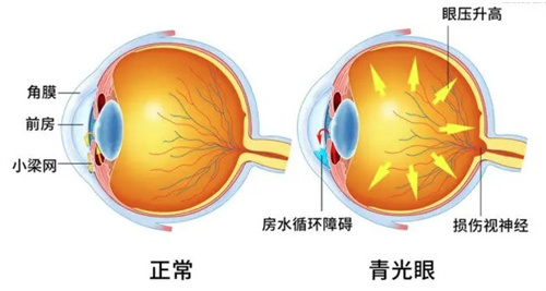 一目了然:区分原发性开角型和闭角型青光眼的关键特征