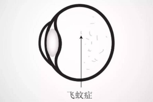 识别飞蚊症恶化信号:眼前乱飞困扰的表现及处理技巧
