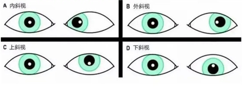 斜视的种类卡通图示意图