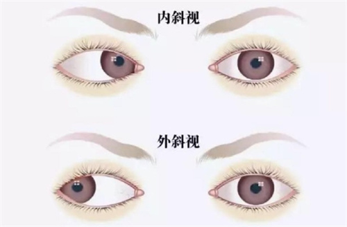 斜视图片内斜视和外斜视