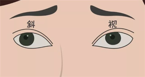 斜视眼睛矫正手术:如何选择适合的年龄进行治疗?