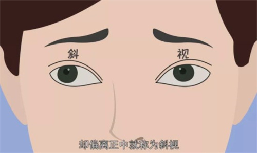 重要揭秘!斜视到底是遗传还是后天因素?