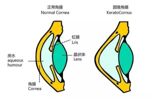 疑似圆锥角膜能做近视眼手术吗?说说圆锥角膜治疗较佳方法、费用、注意事项