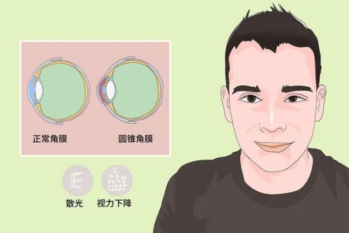 角膜加固手术有没有必要做吗?来看看眼科医生是怎么说的吧!