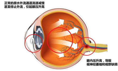 青光眼手术大概需要多少钱？2000-20000元不等！修复方式+特色分享！