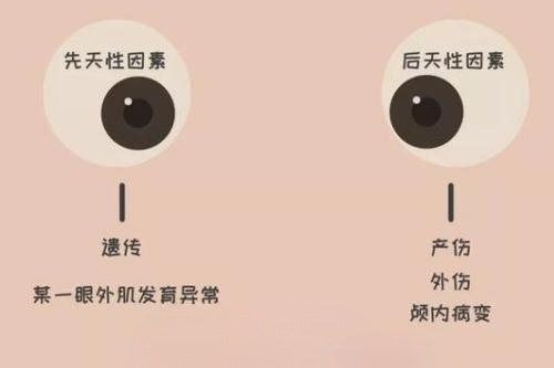 斜视不治疗会怎么样?有什么后果?病情发展以及危害详细讲述!