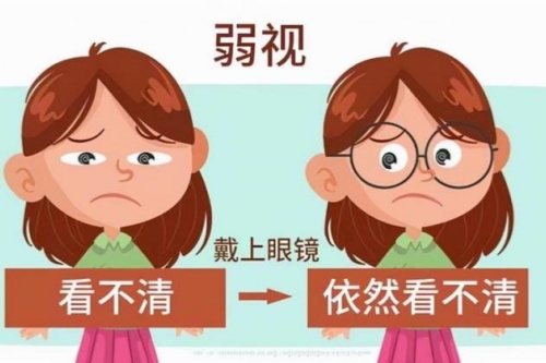 弱视引起的斜视可以治疗吗？可以！文内详细列举具体方法！