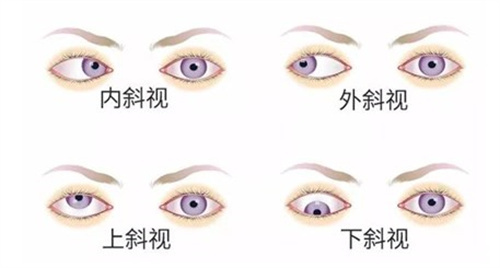 斜视不治会越来越斜吗？斜视手术15岁可以做吗？当然可以！斜视手术适合年龄及必要性