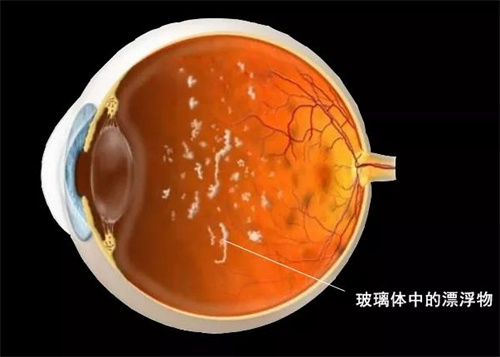 玻璃体浑浊是怎么回事？原因+类型+治疗方式文内详解！