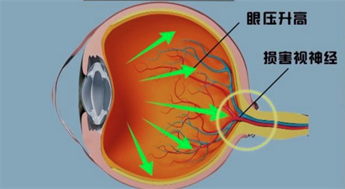 角膜发育异常有什么具体症状?怎么治疗更好呢?详细分析治疗方式以及过程!