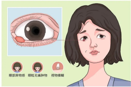 霰粒肿症状图