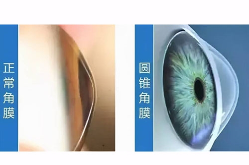 圆锥角膜交联手术能控制几年?说说交联手术可以治好圆锥角膜吗?手术费用是多少?