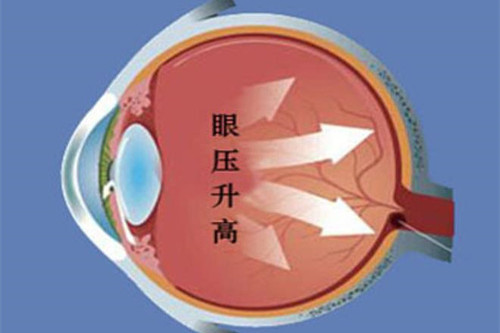 眼压升高卡通图